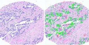 Picture of Computational oncology by deep learning-based analysis of histopathology slide images