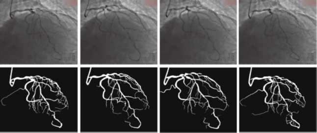 Picture of Coronary angiography video segmentation method for assisting cardiovascular disease interventional treatment