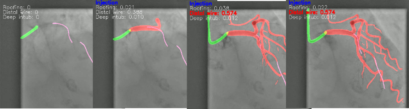 Picture of Coronary angiography video segmentation method for assisting cardiovascular disease interventional treatment