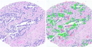 Picture of Analysis  amp; Prediction of Breast Cancer Survival Using Hematoxylin and Eosin (H amp;E) Images Based on Deep Learning Algorithms