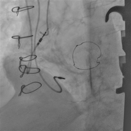 Picture of Optimal segmentation of devices and vessels on 2D fluoroscopy PCI images