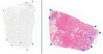 Picture of HER2 status prediction from H amp;E-stained WSI by utilizing HER2-IHC images and automatic tile level annotations in breast cancer.